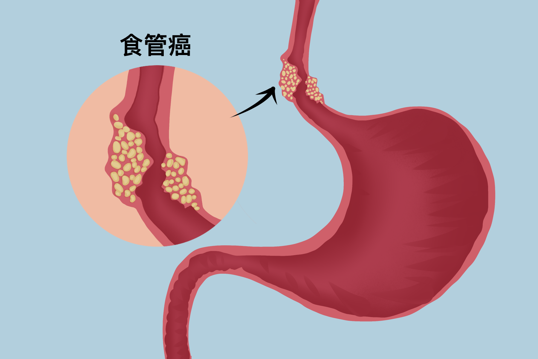 治疗食管癌的又一选择-斯鲁利单抗,提高总生存期4个月