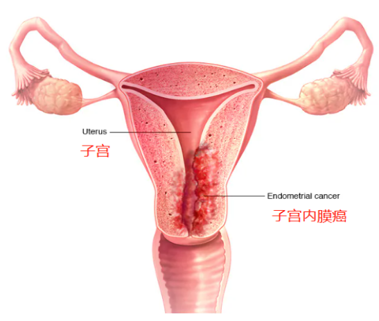 ASCO要闻！多塔利单抗+化疗有奇效,子宫内膜癌有望长期获益