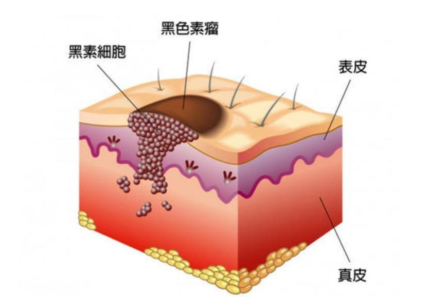 中位生存期延长！比美替尼效果显著