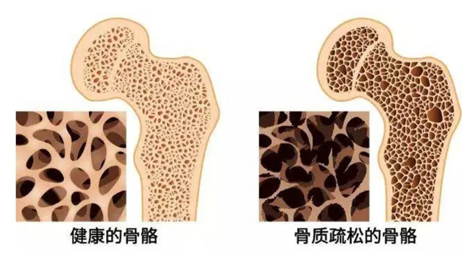 罗莫单抗使绝经后女性骨质疏松骨折风险降低73%！价格如何？ (图1)