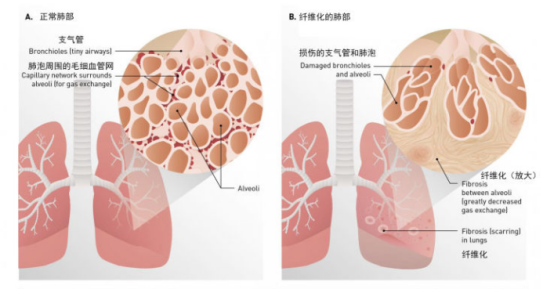 钟南山院士：尼达尼布对于新冠肺纤维化的作用和疗效