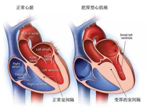肥厚型心肌病新机制！马瓦卡坦改善心肌病症状降低至18%